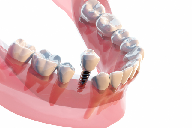 川越（川越駅西口すぐ）の歯医者で歯を失った場合の治療法